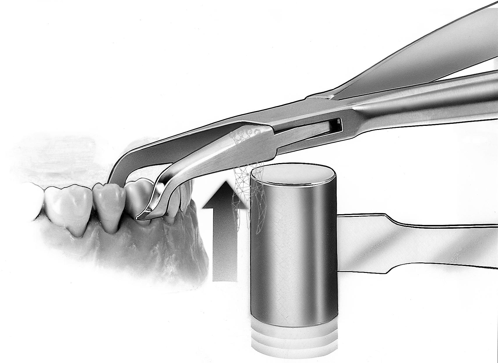 Crown/bridge remover Lindblom