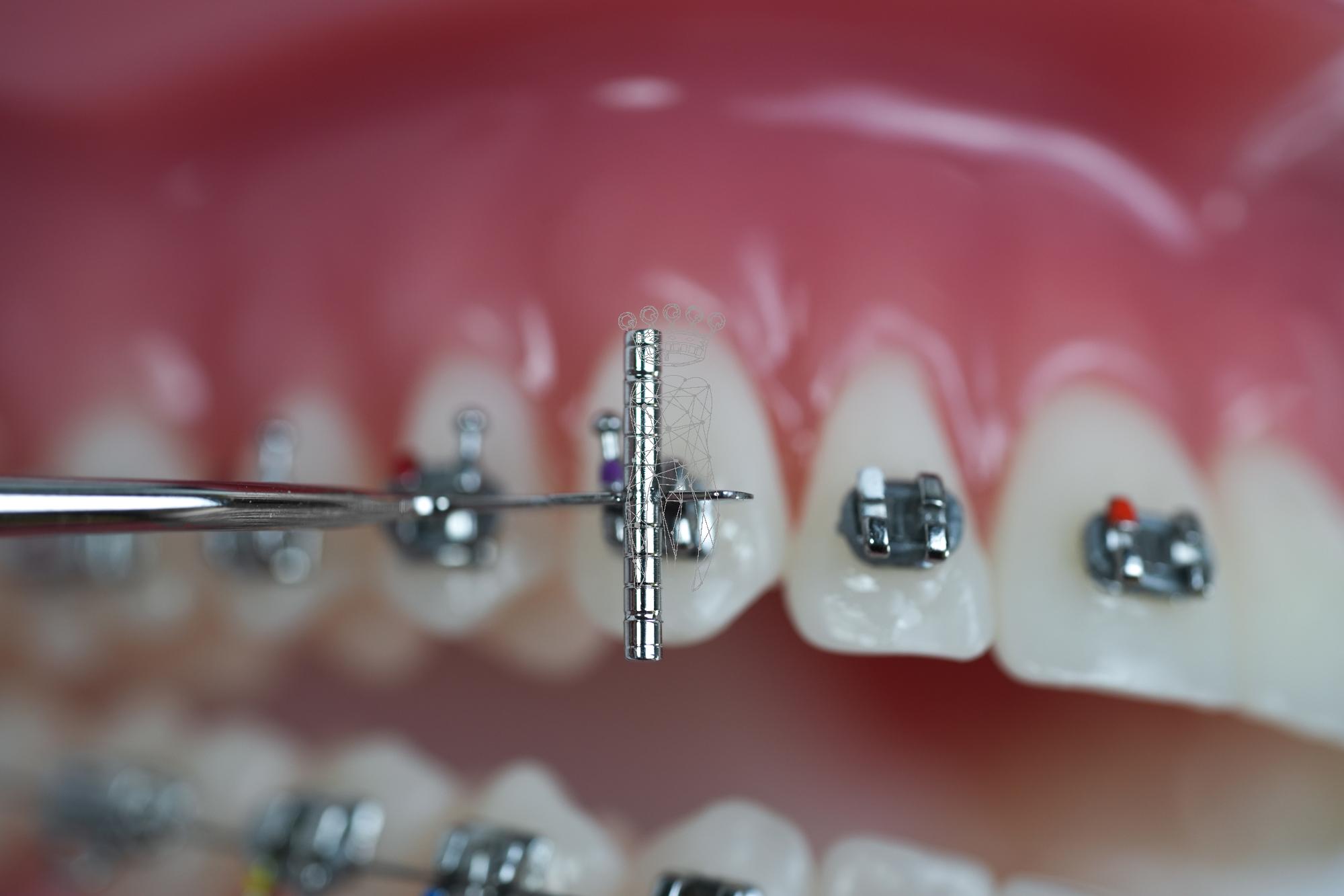 Bracket positioner .018" + scaler acc. to Dr. Chhatwani